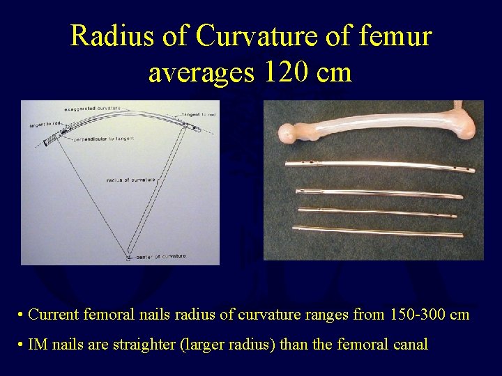 Radius of Curvature of femur averages 120 cm • Current femoral nails radius of