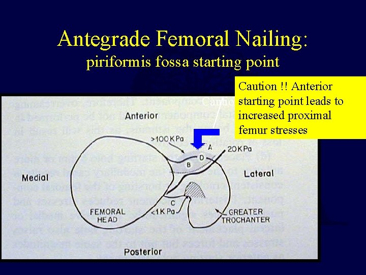 Antegrade Femoral Nailing: piriformis fossa starting point Caution !! Anterior point leads to Cautionstarting