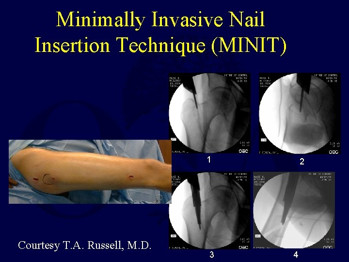 Minimally Invasive Nail Insertion Technique (MINIT) 1 Courtesy T. A. Russell, M. D. 3