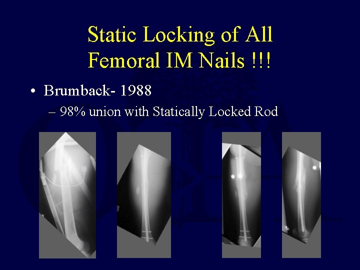 Static Locking of All Femoral IM Nails !!! • Brumback- 1988 – 98% union