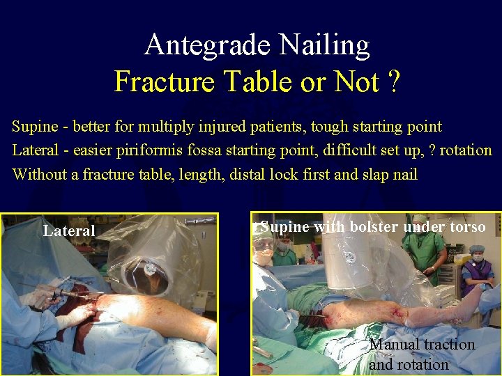 Antegrade Nailing Fracture Table or Not ? Supine - better for multiply injured patients,