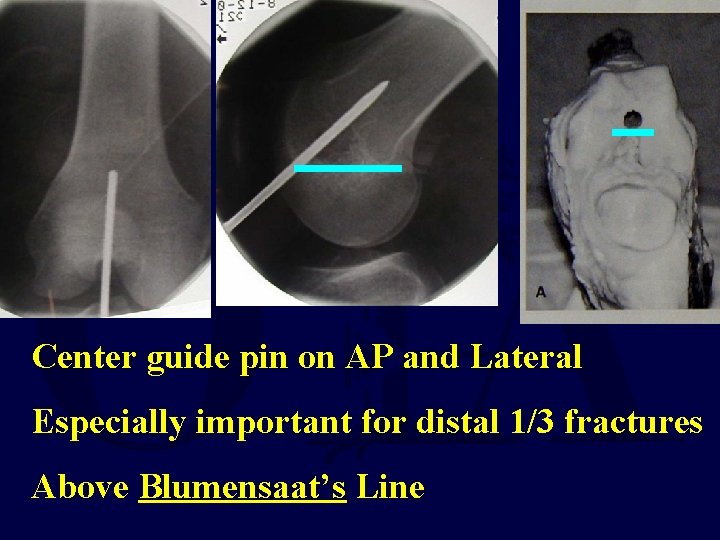 Center guide pin on AP and Lateral Especially important for distal 1/3 fractures Above