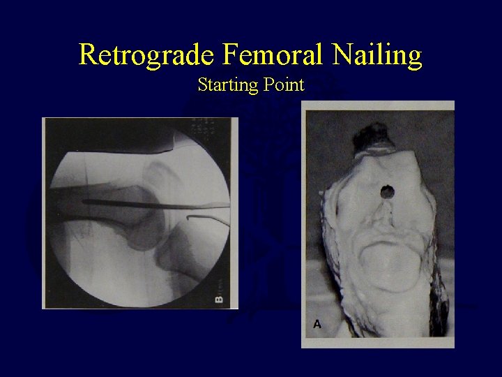 Retrograde Femoral Nailing Starting Point 