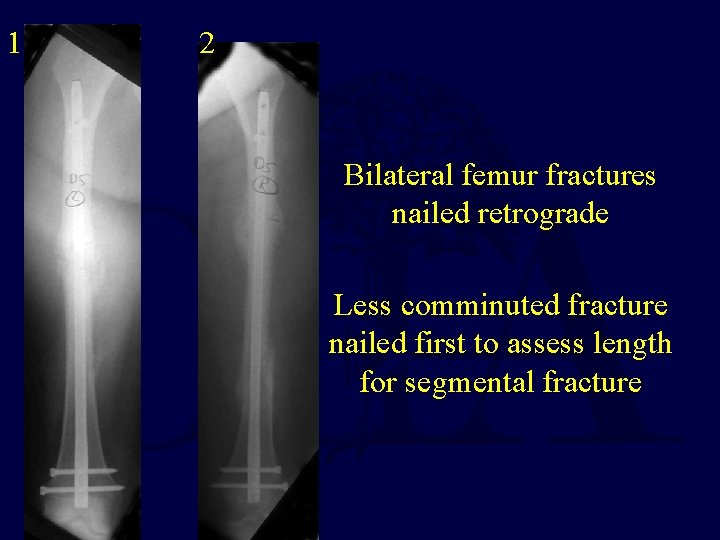 1 2 Bilateral femur fractures nailed retrograde Less comminuted fracture nailed first to assess