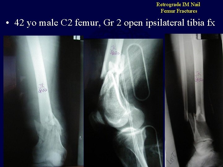 Retrograde IM Nail Femur Fractures • 42 yo male C 2 femur, Gr 2