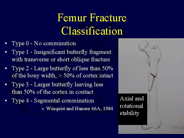 Femur Fracture Classification • Type 0 - No comminution • Type 1 - Insignificant