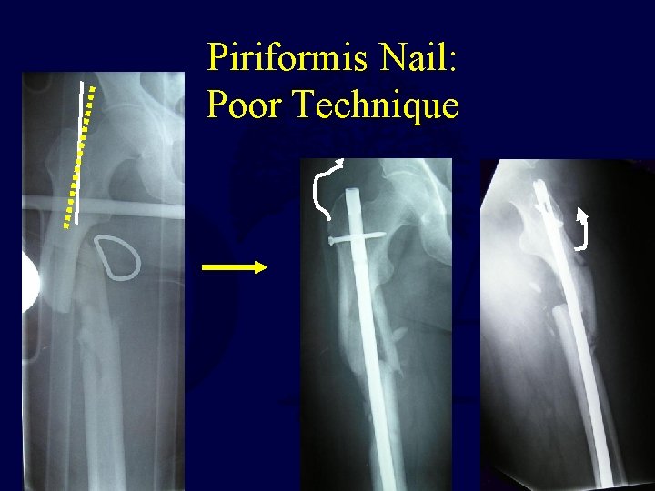 Piriformis Nail: Poor Technique 
