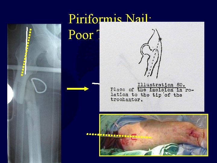 Piriformis Nail: Poor Technique 