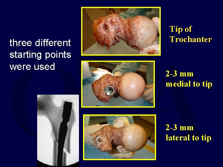three different starting points were used Tip of Trochanter 2 -3 mm medial to