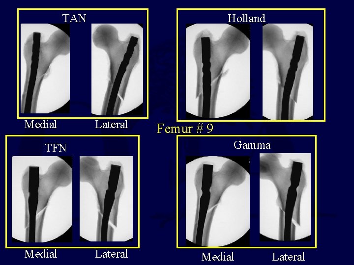 TAN Medial Holland Lateral Gamma TFN Medial Femur # 9 Lateral Medial Lateral 
