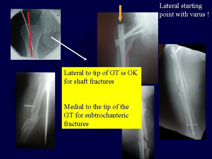 Lateral starting point with varus ! Lateral to tip of GT is OK for