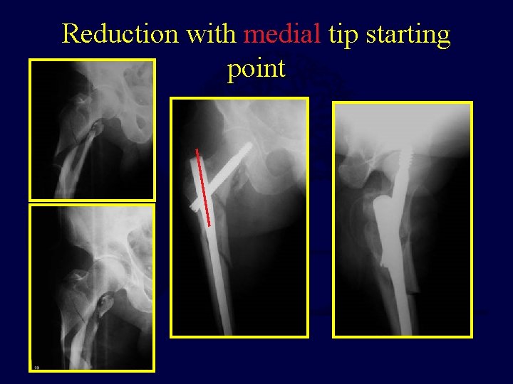 Reduction with medial tip starting point 