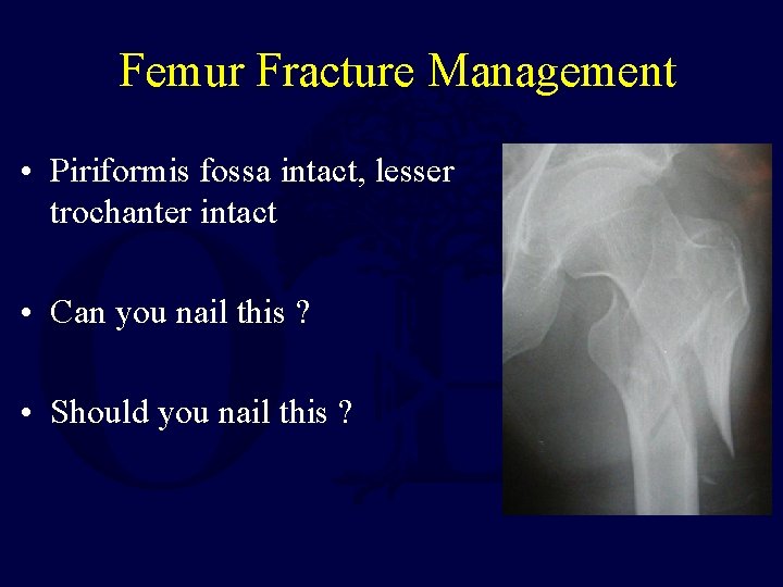 Femur Fracture Management • Piriformis fossa intact, lesser trochanter intact • Can you nail