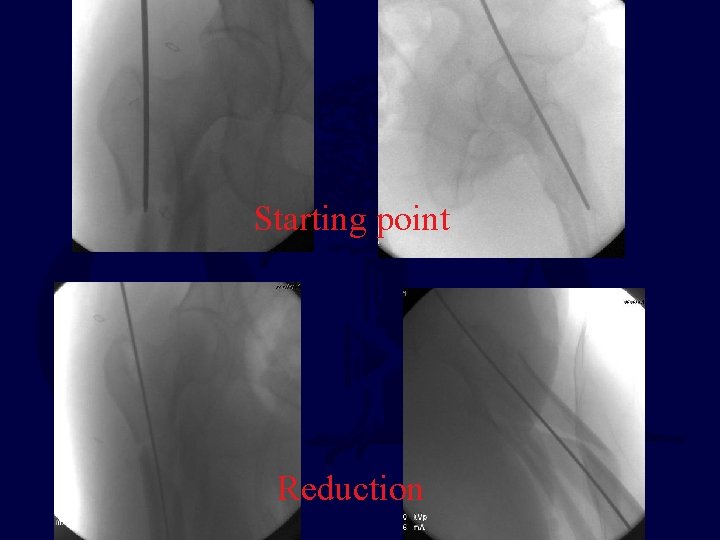 Starting point Reduction 