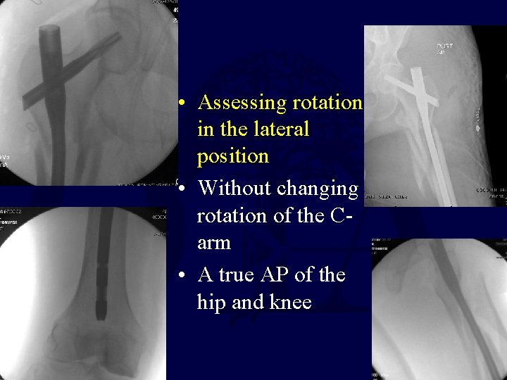  • Assessing rotation in the lateral position • Without changing rotation of the