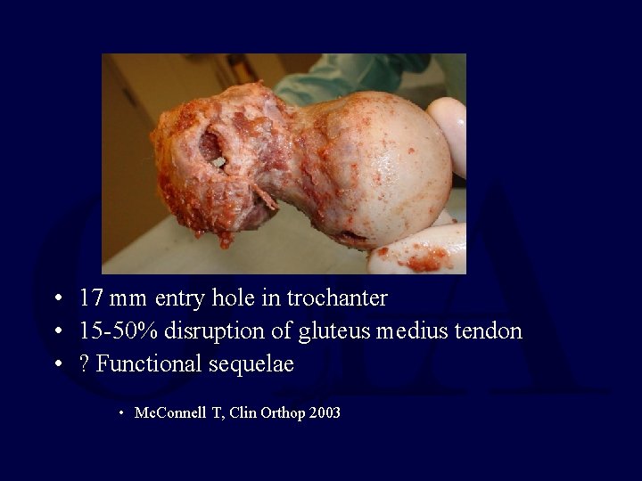  • 17 mm entry hole in trochanter • 15 -50% disruption of gluteus