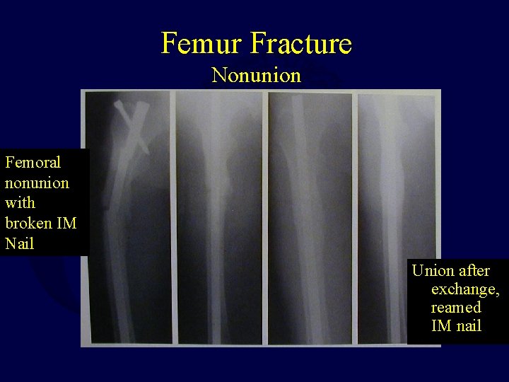 Femur Fracture Nonunion Femoral nonunion with broken IM Nail Union after exchange, reamed IM