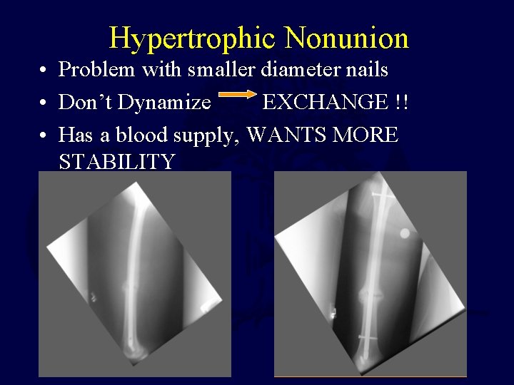 Hypertrophic Nonunion • Problem with smaller diameter nails • Don’t Dynamize EXCHANGE !! •