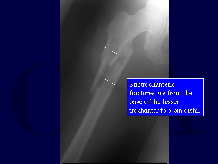 Subtrochanteric fractures are from the base of the lesser trochanter to 5 cm distal