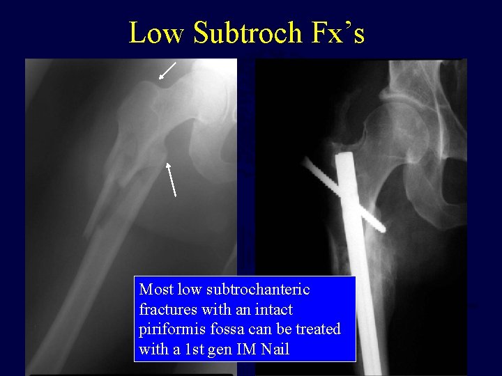 Low Subtroch Fx’s Most low subtrochanteric fractures with an intact piriformis fossa can be