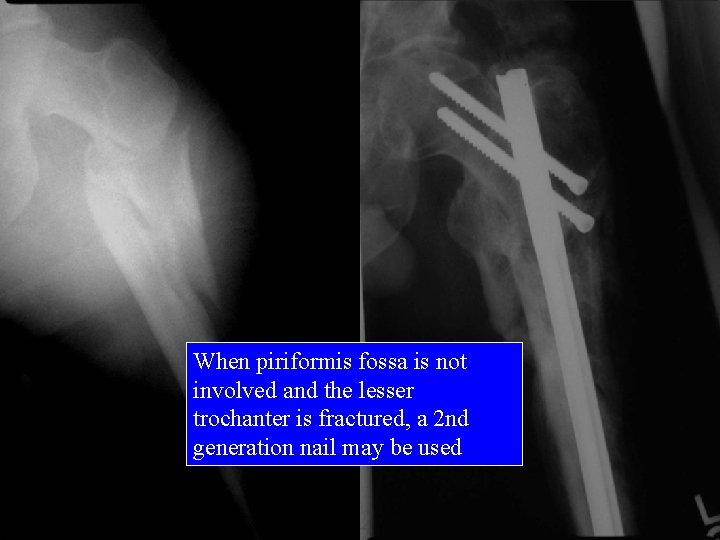 When piriformis fossa is not involved and the lesser trochanter is fractured, a 2