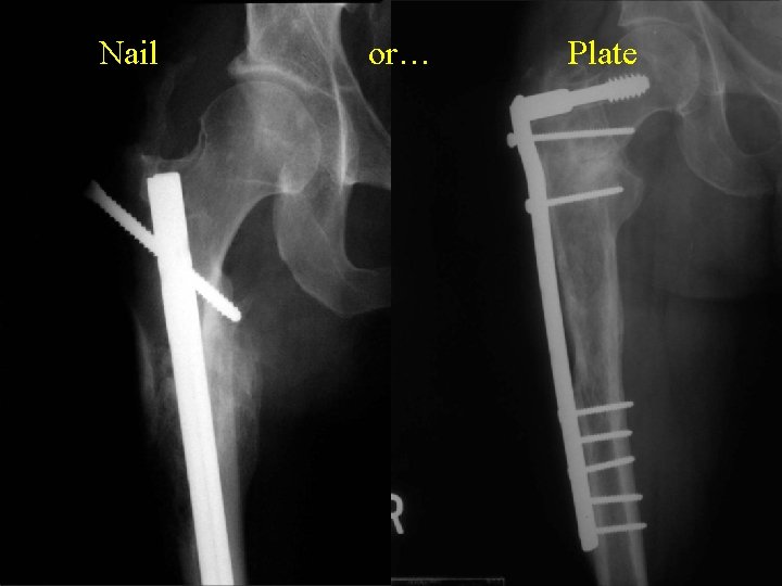 Nail or… Plate 