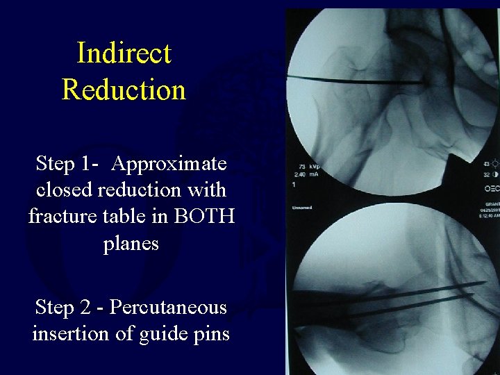 Indirect Reduction Step 1 - Approximate closed reduction with fracture table in BOTH planes