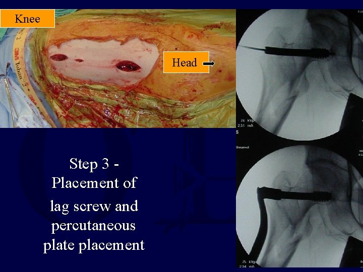 Knee Head Step 3 Placement of lag screw and percutaneous plate placement 