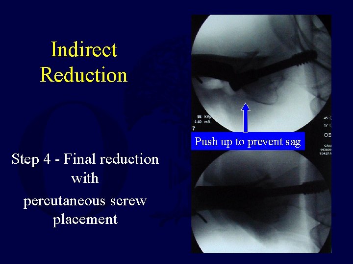 Indirect Reduction Push up to prevent sag Step 4 - Final reduction with percutaneous