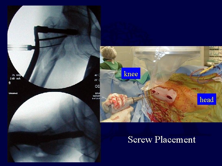 knee head Screw Placement 