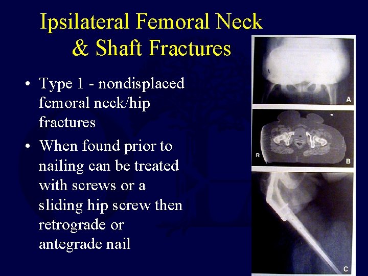 Ipsilateral Femoral Neck & Shaft Fractures • Type 1 - nondisplaced femoral neck/hip fractures