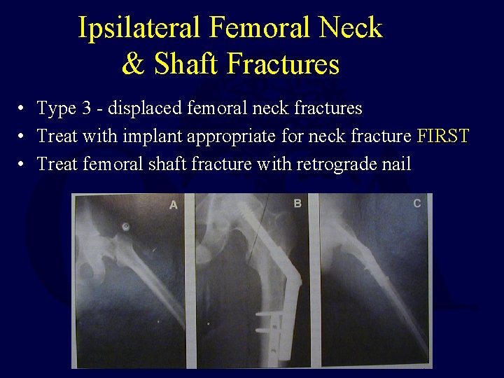 Ipsilateral Femoral Neck & Shaft Fractures • Type 3 - displaced femoral neck fractures