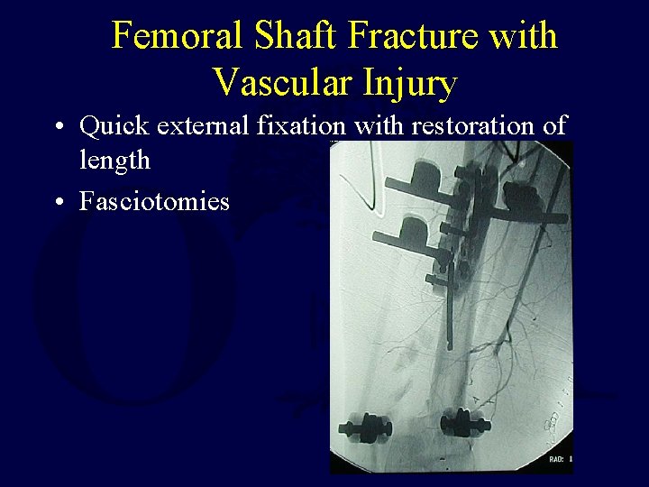 Femoral Shaft Fracture with Vascular Injury • Quick external fixation with restoration of length