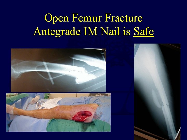 Open Femur Fracture Antegrade IM Nail is Safe 