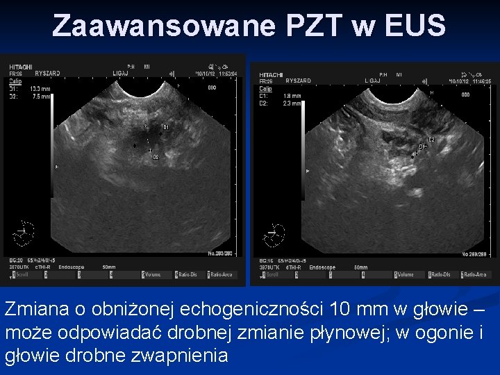 Zaawansowane PZT w EUS Zmiana o obniżonej echogeniczności 10 mm w głowie – może