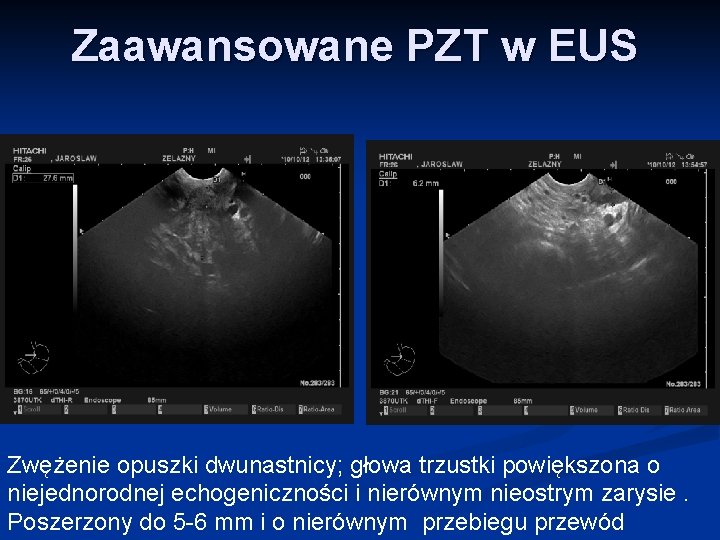 Zaawansowane PZT w EUS Zwężenie opuszki dwunastnicy; głowa trzustki powiększona o niejednorodnej echogeniczności i