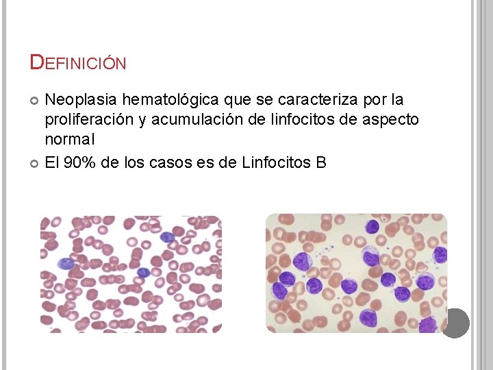 DEFINICIÓN Neoplasia hematológica que se caracteriza por la proliferación y acumulación de linfocitos de