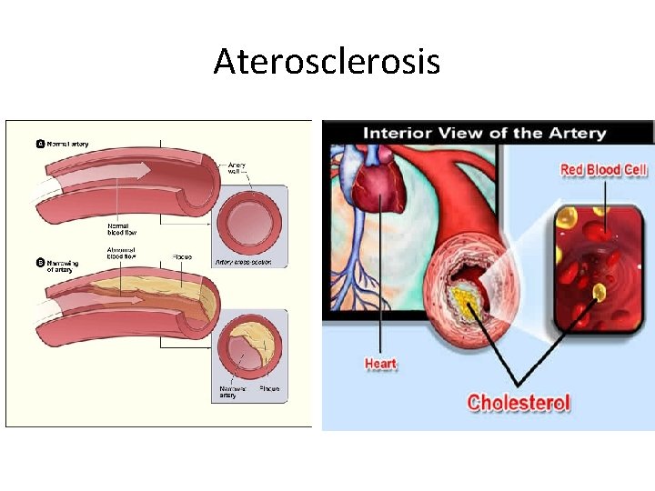 Aterosclerosis 