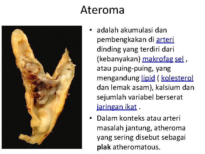 Ateroma • adalah akumulasi dan pembengkakan di arteri dinding yang terdiri dari (kebanyakan) makrofag