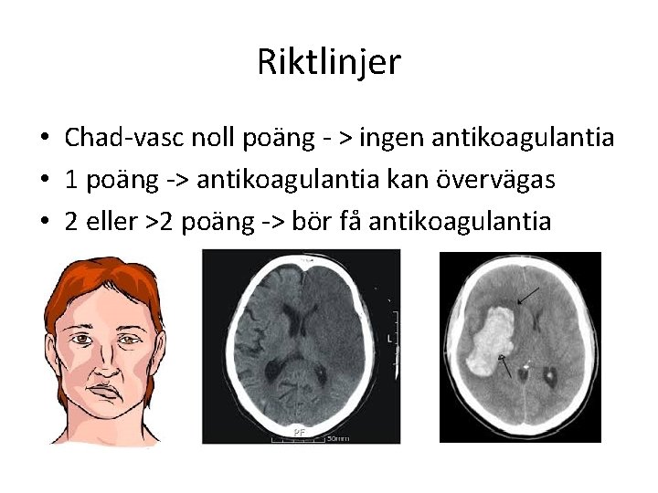 Riktlinjer • Chad-vasc noll poäng - > ingen antikoagulantia • 1 poäng -> antikoagulantia