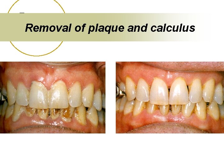 Removal of plaque and calculus 