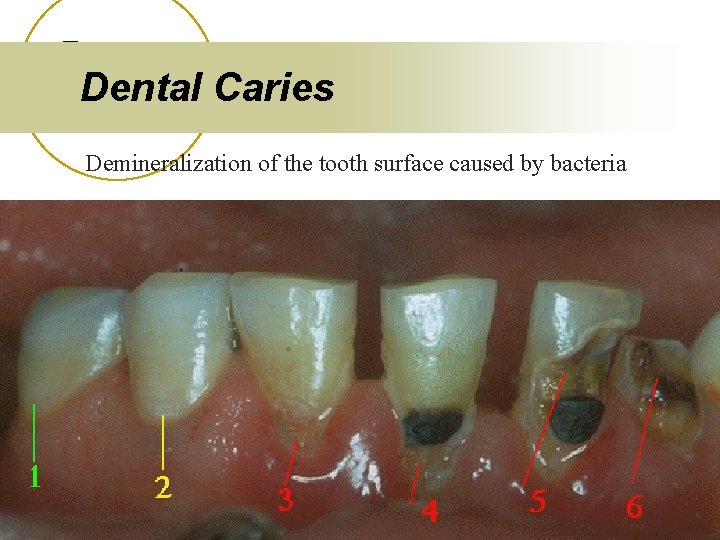 Dental Caries Demineralization of the tooth surface caused by bacteria 