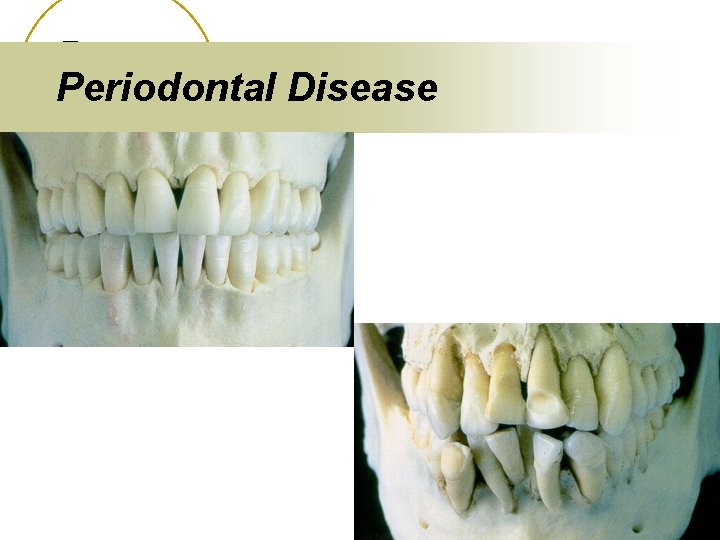Periodontal Disease 
