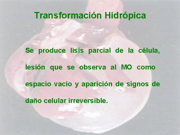 Transformación Hidrópica Se produce lisis parcial de la célula, lesión que se observa al