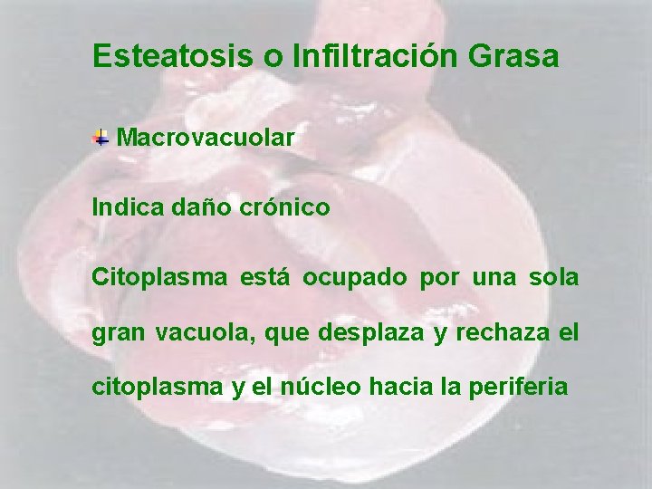 Esteatosis o Infiltración Grasa Macrovacuolar Indica daño crónico Citoplasma está ocupado por una sola