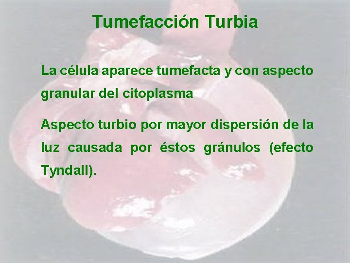 Tumefacción Turbia La célula aparece tumefacta y con aspecto granular del citoplasma Aspecto turbio