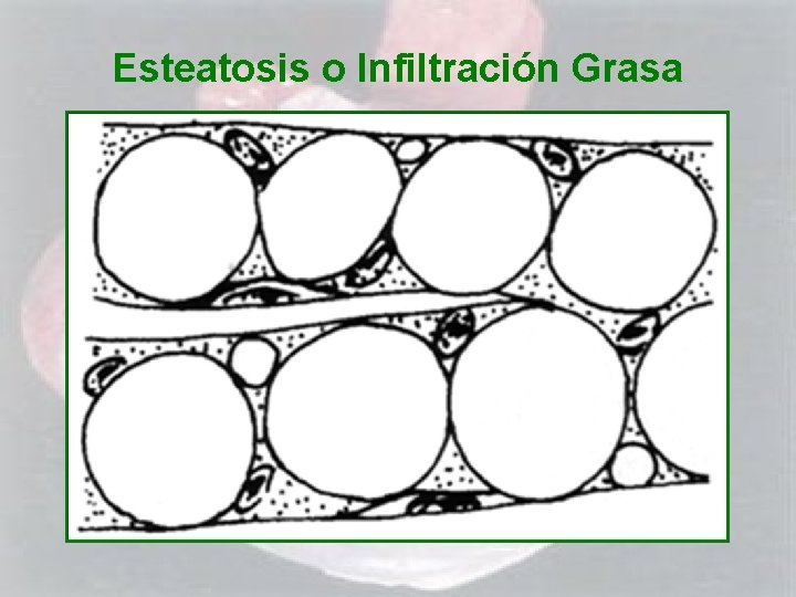 Esteatosis o Infiltración Grasa 