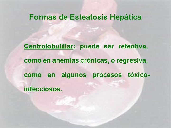 Formas de Esteatosis Hepática Centrolobulillar: Centrolobulillar puede ser retentiva, como en anemias crónicas, o