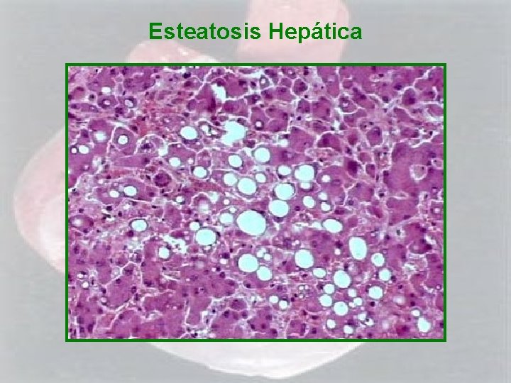 Esteatosis Hepática 