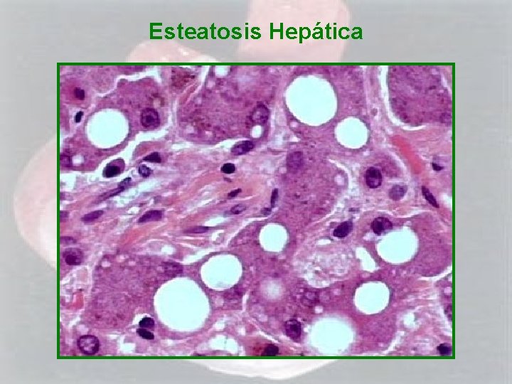 Esteatosis Hepática 